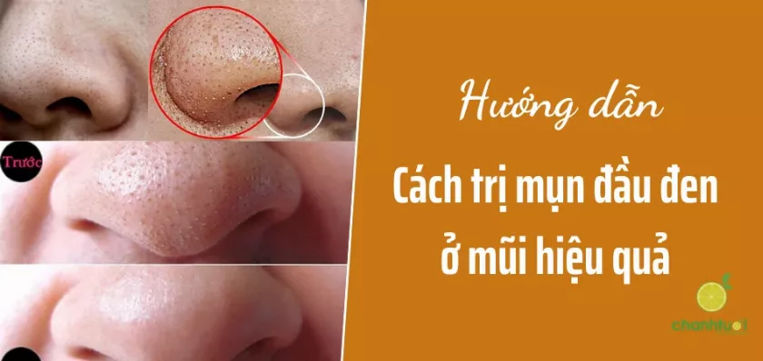 4 cách trị mụn đầu đen ở mũi tại nhà nhanh và hiệu quả