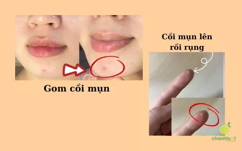 alt: Kem chấm mụn Tia'm giúp gom cồi mụn hiệu quả