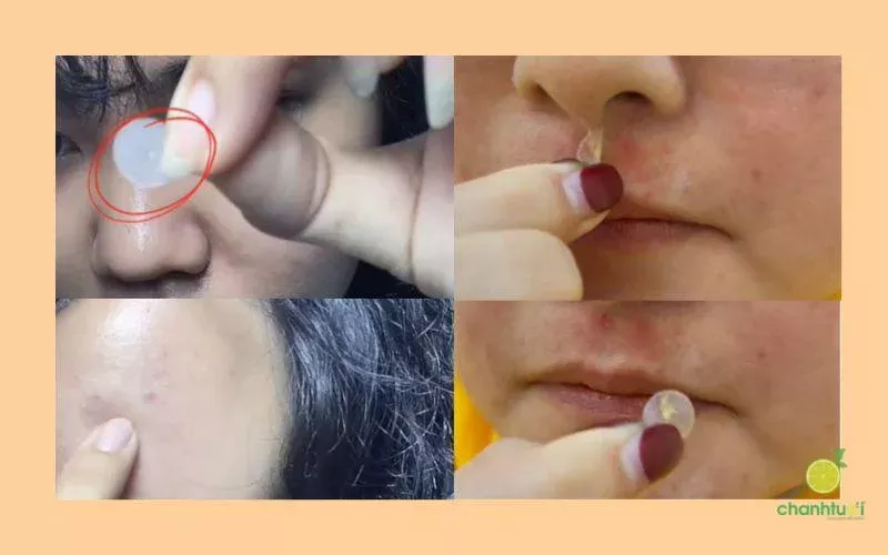 alt: Miếng dán mụn Acnes sau khi sử dụng