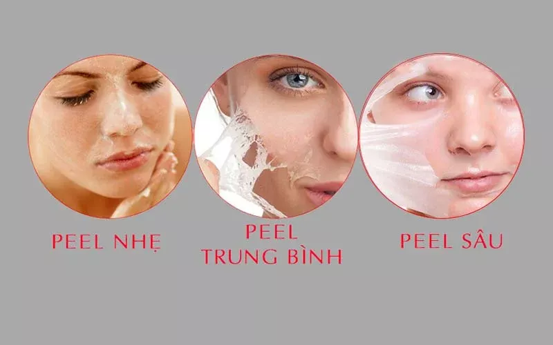 Các loại peel da