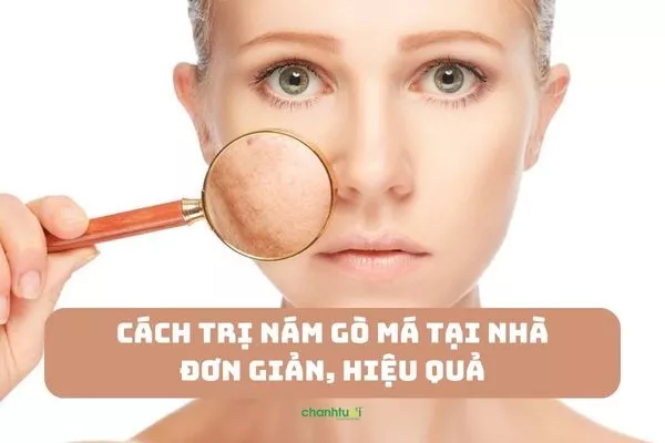 Cách trị nám gò má tại nhà