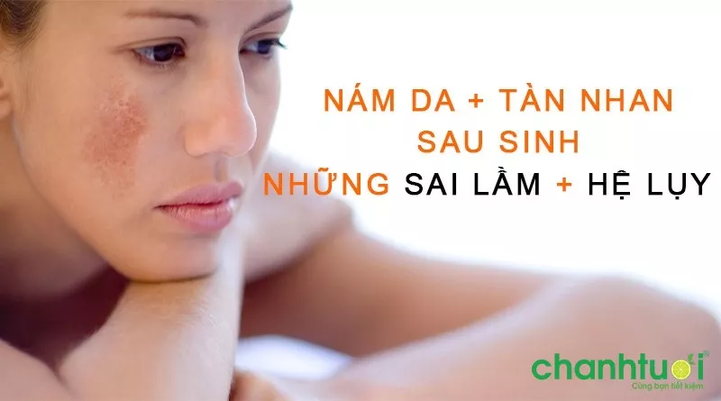 cách trị nám sau sinh