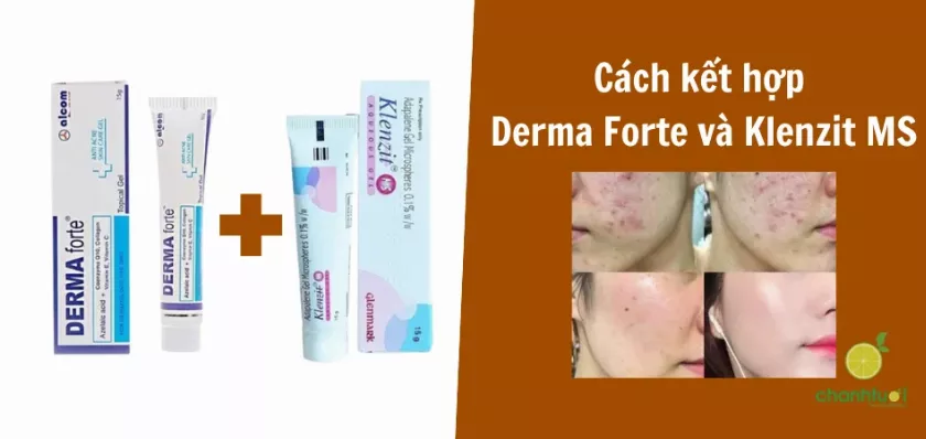 Kết hợp Derma Forte và Klenzit MS trị mụn