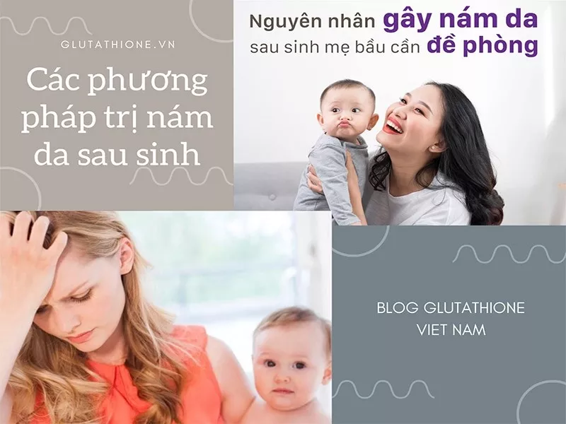 Mách mẹ các cách trị nám sau sinh - xua tan nỗi tự ti về ngoại hình hậu thai kỳ