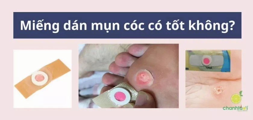 Miếng dán mụn cóc