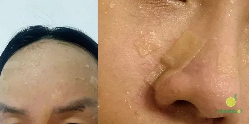 miếng dán mụn duoderm cảm nhận