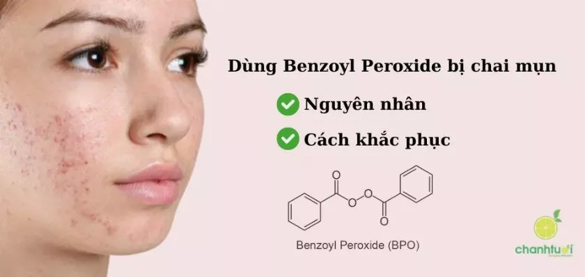 Mô tả ảnh: Chai thuốc trị mụn Benzoyl Peroxide