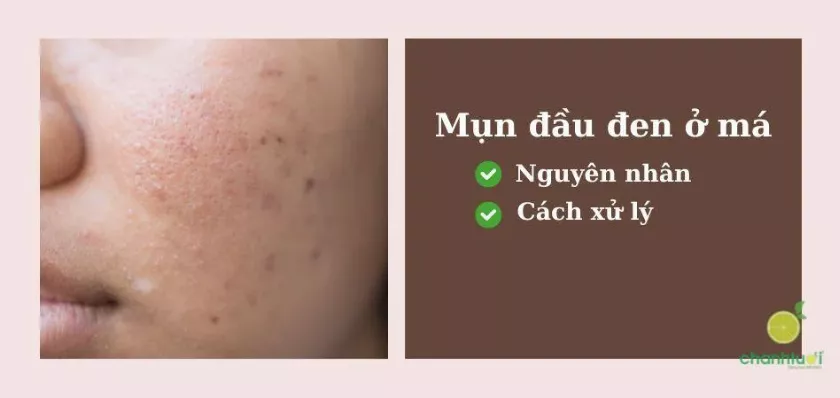 Mụn đầu đen ở má: Nguyên nhân và cách điều trị hiệu quả