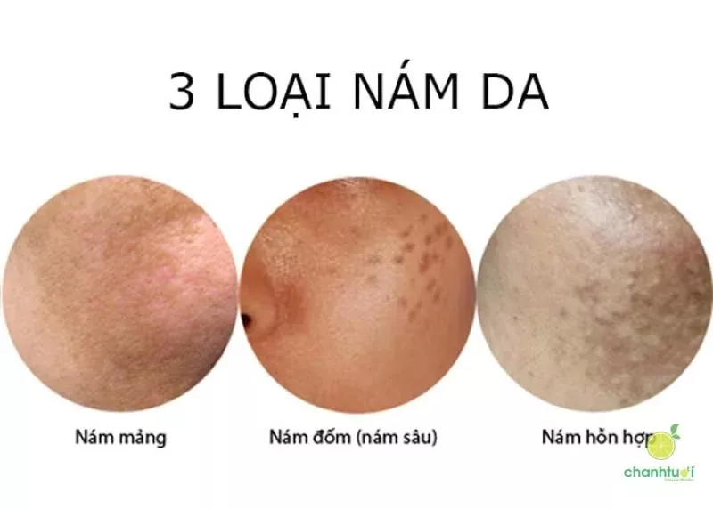 nám da mặt vùng má 2