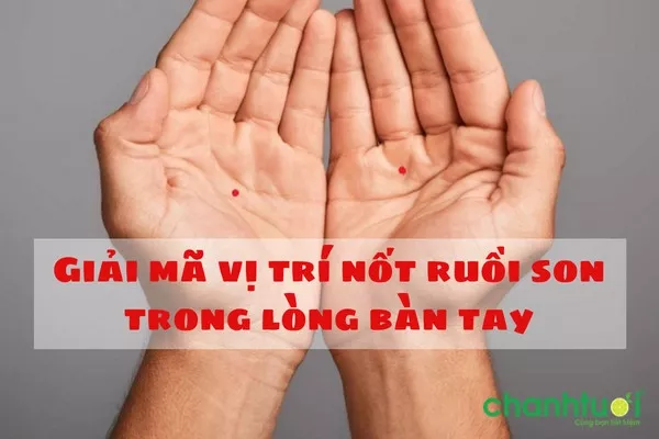 Nốt ruồi son trong lòng bàn tay