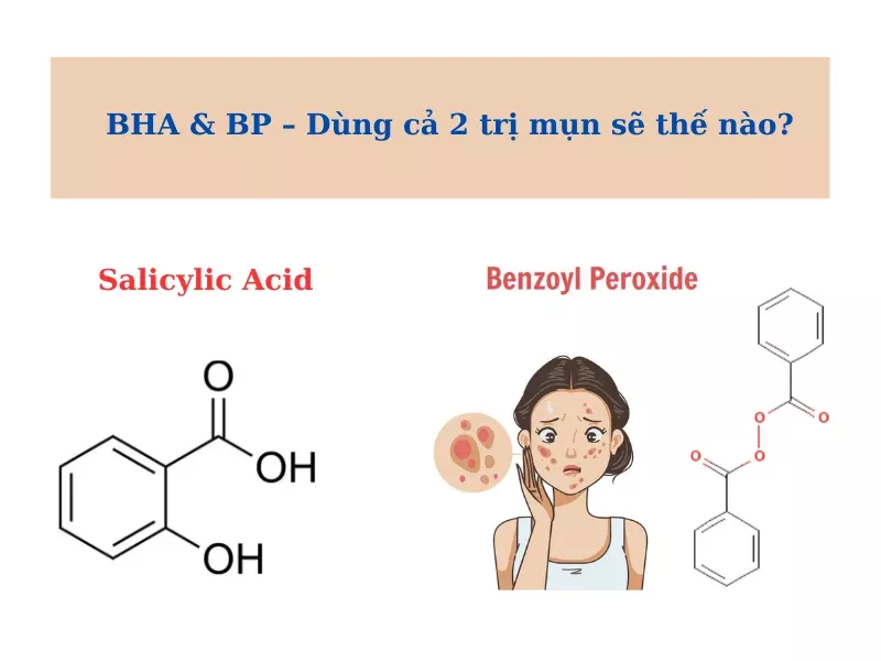 Salicylic Acid và Benzoyl peroxide (4)