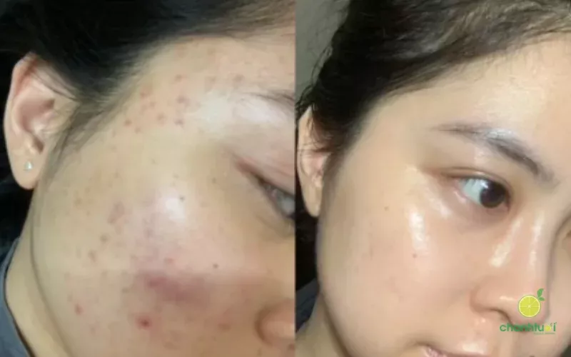 sữa rửa mặt skin gsv hiệu quả