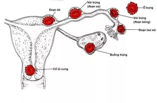 Thai ngoài tử cung