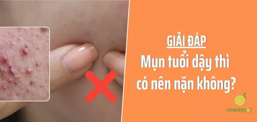 alt text: Hình ảnh về mụn tuổi dậy thì