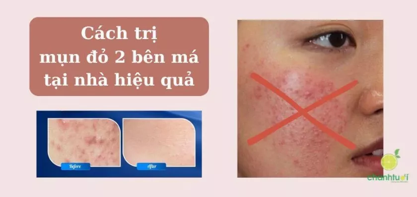 Cách trị mụn đỏ hai bên má tại nhà an toàn và hiệu quả