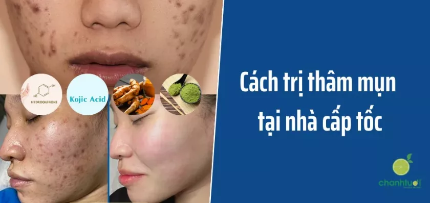 Cách trị thâm mụn tại nhà