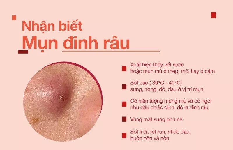 Dấu hiệu của mụn đinh râu