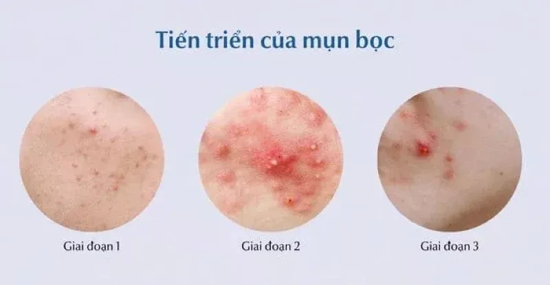 mụn bọc là gì 7