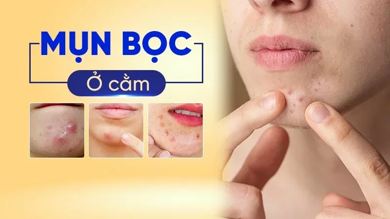 mụn bọc ở cằm 3