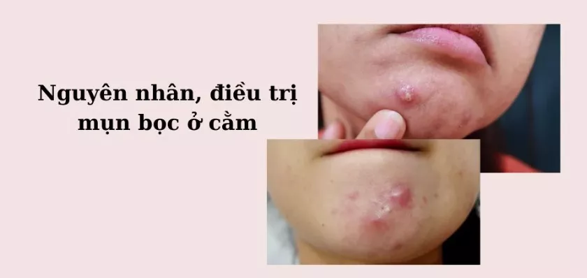 Mụn bọc ở cằm: Nguyên nhân, điều trị và cách phòng ngừa