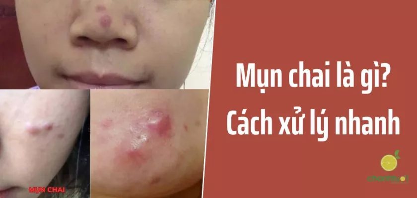 Mụn chai là gì? Nguyên nhân, cách điều trị hiệu quả, không sẹo