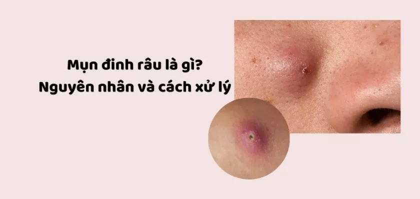 Mụn đinh râu ở cằm