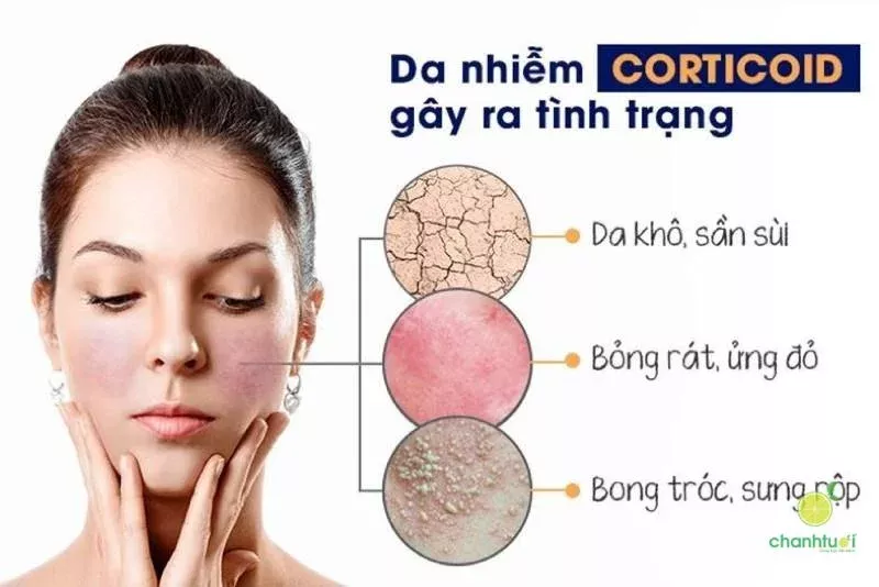 Nguyên nhân gây da nhiễm Corticoid