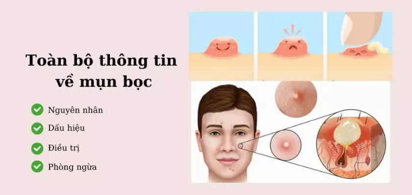 Nguyên nhân mụn bọc là gì? Có nên nặn mụn bọc hay không?