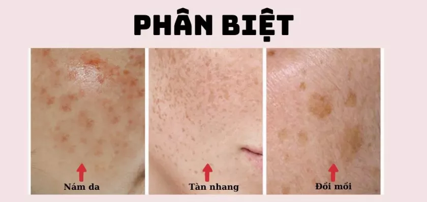 Phân biệt nám, tàn nhang và đồi mồi