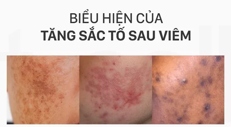 Phân loại thâm sau viêm