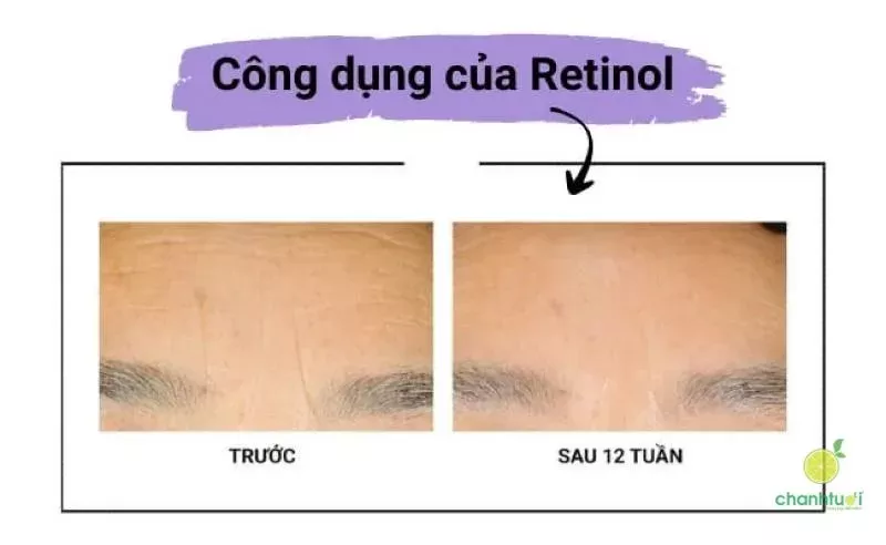 Tác dụng của Retinol