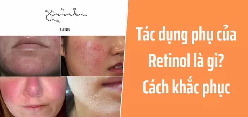 Tác dụng phụ của Retinol là gì? Cách khắc phục hiệu quả