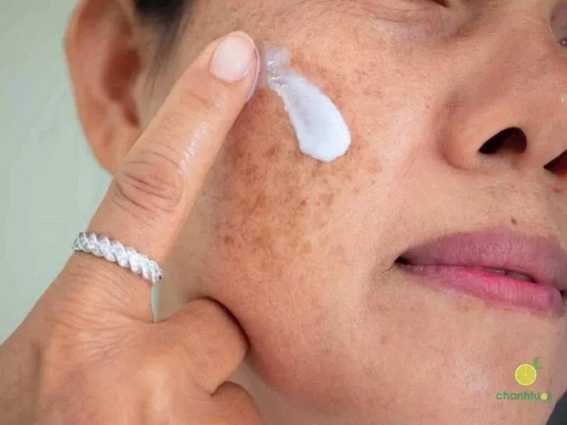 Mỹ phẩm chăm sóc da sau đốt tàn nhang