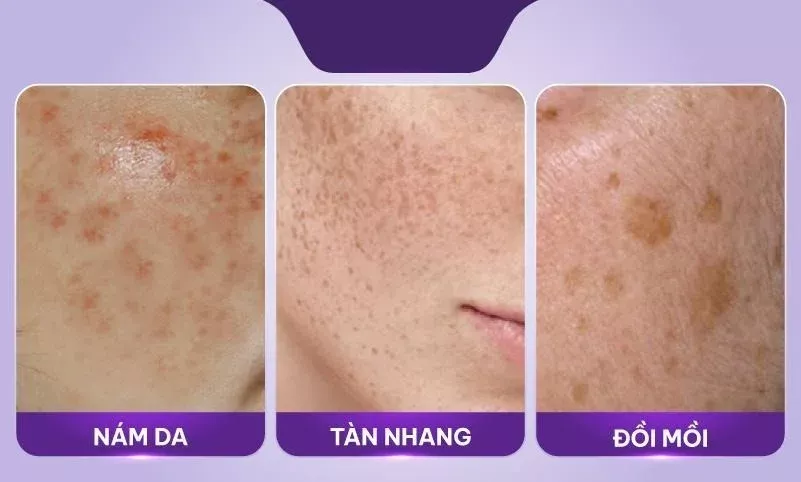 Bảng phân biệt nám, tàn nhang, đồi mồi